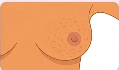 Illustration : une peau qui ressemble à une peau d'orange